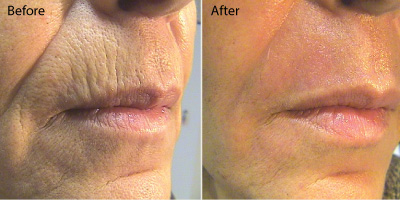 Resurfacing for Aging Skin