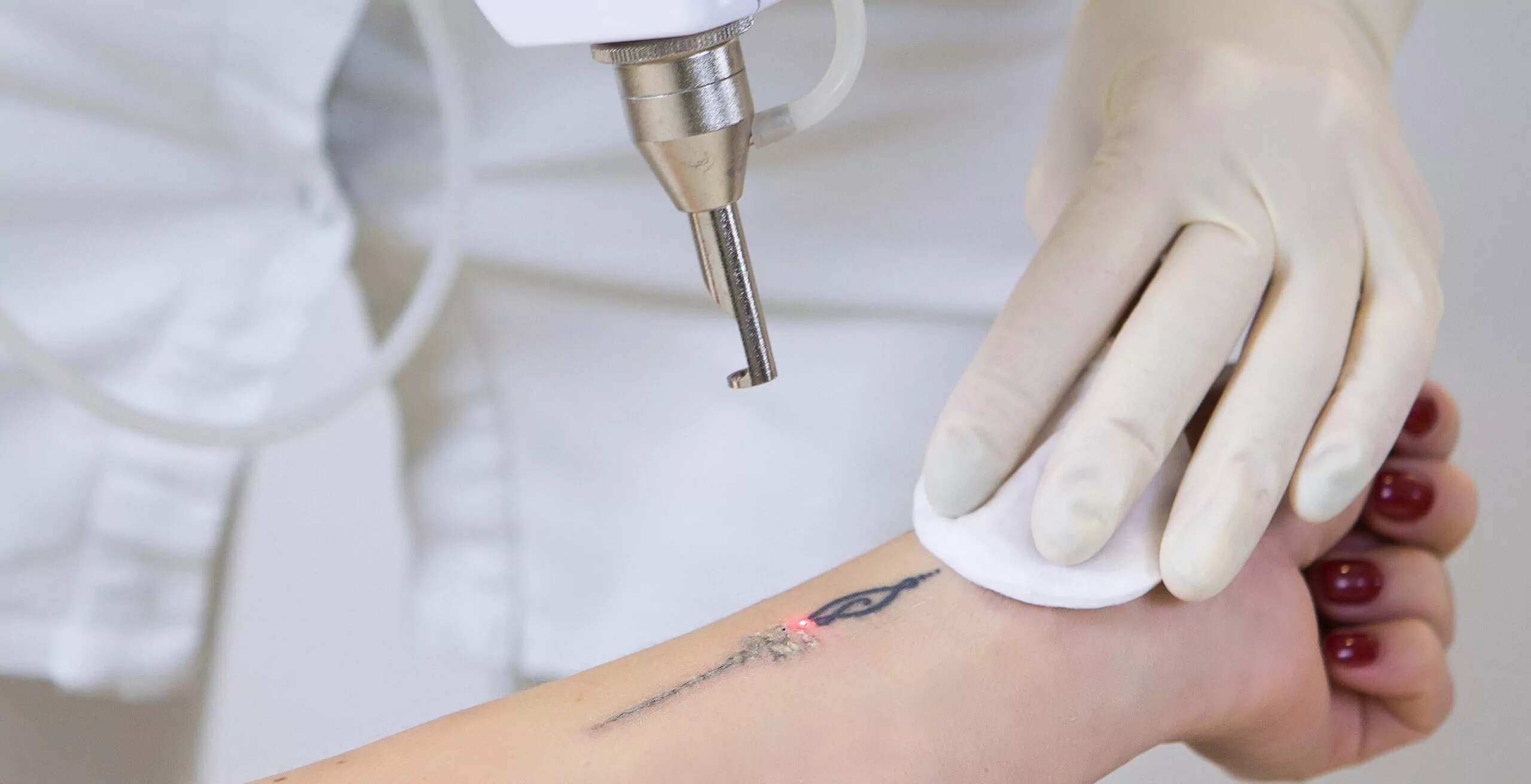 Tattoo Removal