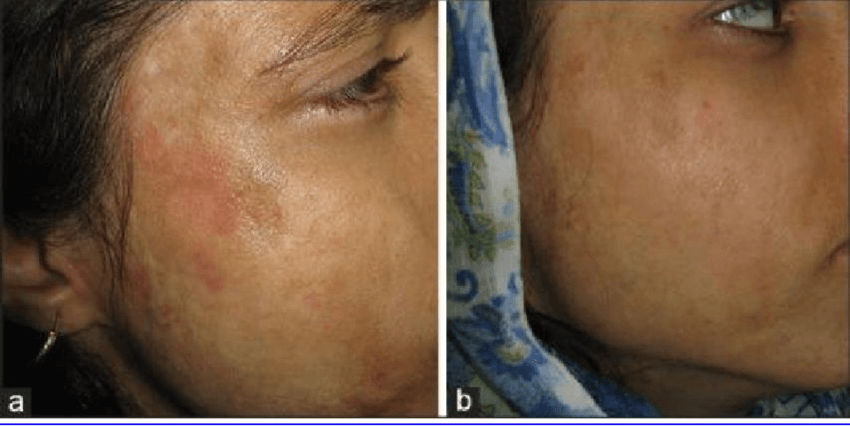 Fractional Laser for Burn Scars