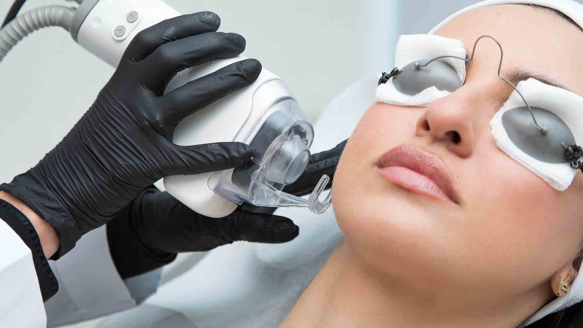 Fractional Laser for Face