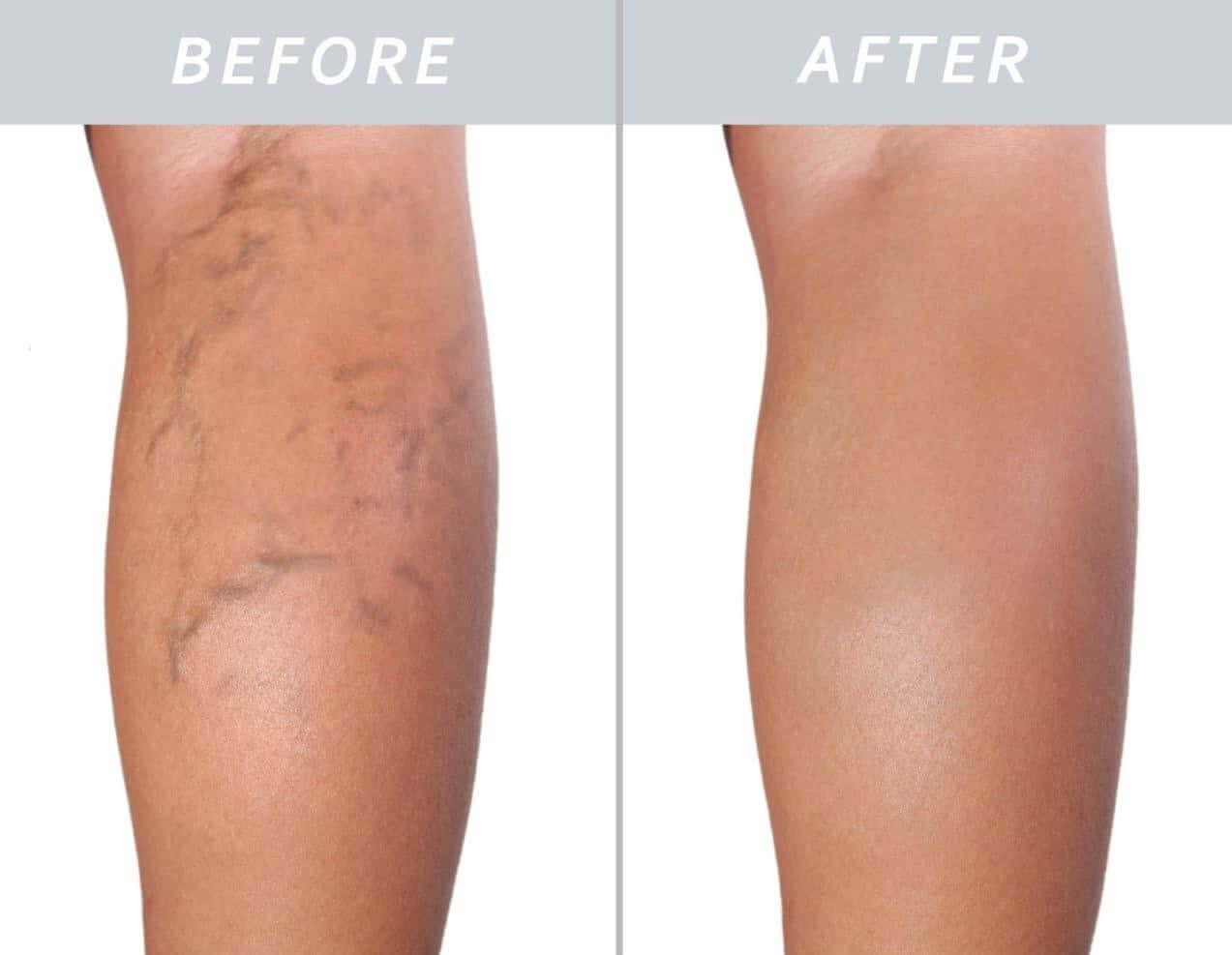 Laser removal of varicose veins