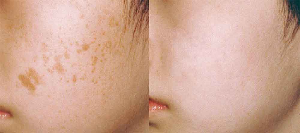 Laser Pigmentation Removal