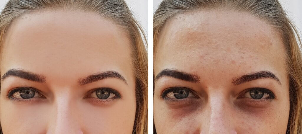 Revitalize Your Eyes with Carboxy Therapy by Reem Tryaq