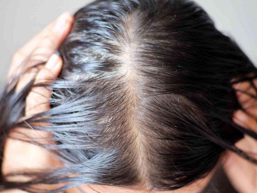 Hair Loss Treatment